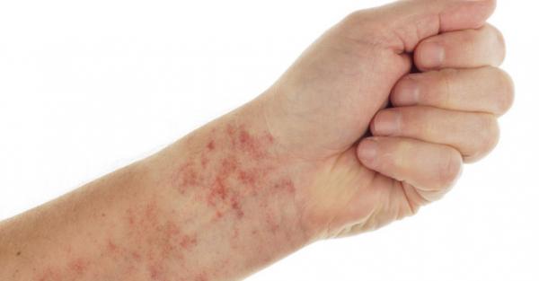 腎病健康線上 | 這種不起眼的面板小瘀點，居然是腎臟的警告！