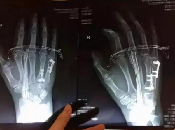 骨折後,鋼板不取出留在體內會怎樣?有沒有副作用? 骨折後,鋼板不取出留在體內會怎樣?有沒有副作用?