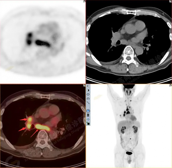 肺結節看診（13）：肺小結節全身廣泛轉移2例，PET分期：晚期