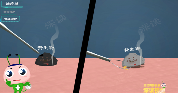 藥物腐蝕？液氮冷凍？鐳射灼燒？到底誰才能根治尖銳溼疣？