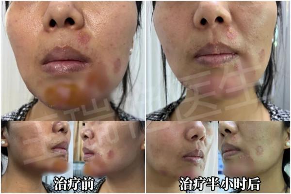 這些祛痘藥可能爛臉！如何預防爛臉？