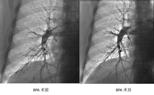 壹點醫典|70歲老人患肺動脈高壓,這個手術顯著改善肺迴圈 壹點醫典|70歲老人患肺動脈高壓,這個手術顯著改善肺迴圈