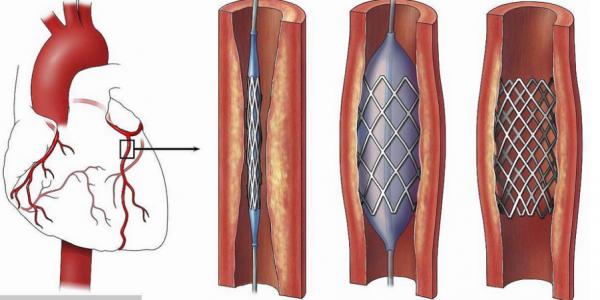 全國科普日：醫生靠什麼評估冠心病