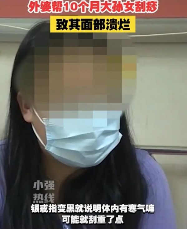 10個月女嬰，被家人刮痧毀了臉