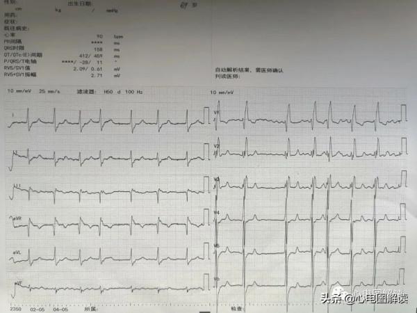 心房顫動?完全性右束支阻滯?心肌病? 心房顫動?完全性右束支阻滯?心肌病?
