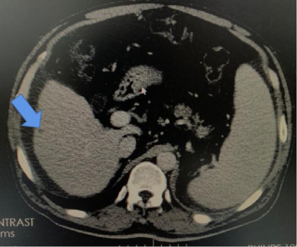 去醫院體檢，CT報告上那些不用過於擔心的診斷結果
