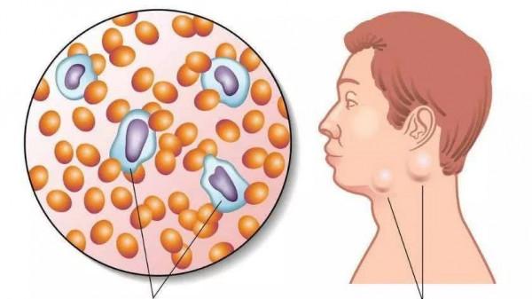 哪些原因可以引起淋巴結腫大？發現淋巴結腫大應該怎麼辦？