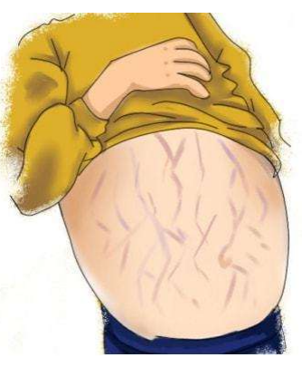 肝腹水治療的原則與措施，專家來告訴你