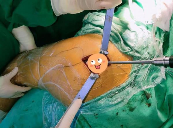 老年股骨頭壞死系列之人工全髖關節置換術&mdash;&mdash;最新微創手術入路