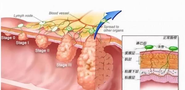 這樣的大便，可能預示著大腸癌上身