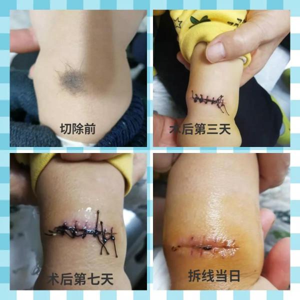 孩子黑毛痣切除後，當媽的自己動手換藥拆線全搞定