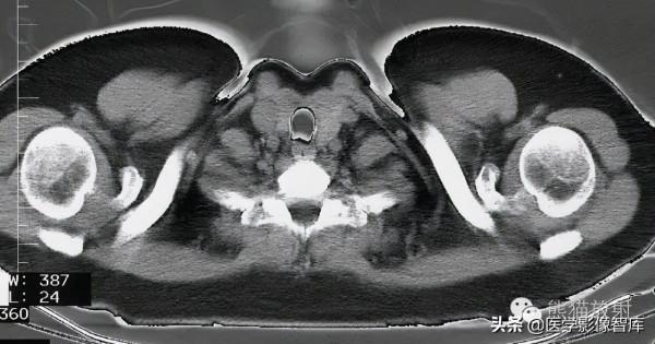 CT斷層解剖圖譜最全總結「推薦收藏」 CT斷層解剖圖譜最全總結「推薦收藏」