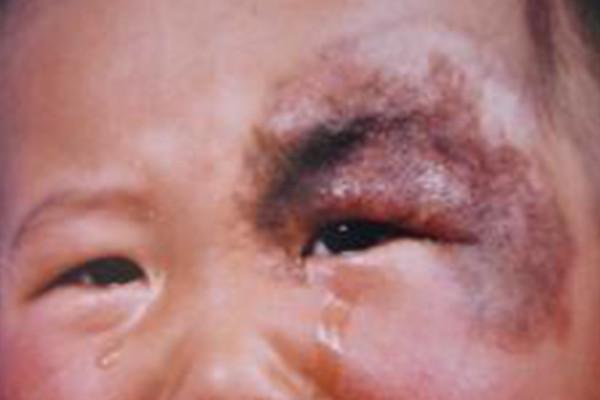 咖啡斑到底是什麼？該如何正確治療？