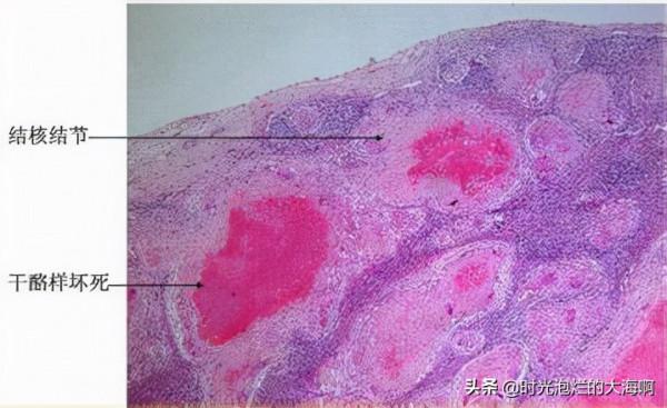 關於“肺結核”的幾點認識