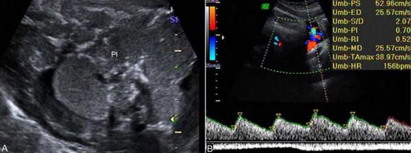 明明白白做超聲32-18：過期妊娠超聲檢查