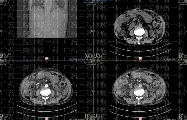 廣藥三院腫瘤一科丨淋巴瘤患者如何應對“腹水”難收