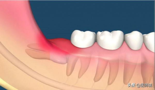智齒為何總是成年出現?科學家給出結論,下巴空間有限 智齒為何總是成年出現?科學家給出結論,下巴空間有限