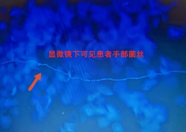清洗過度,老人雙手竟染上“腳氣” 清洗過度,老人雙手竟染上“腳氣”
