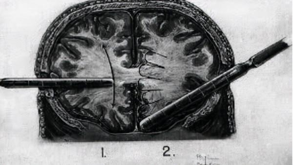 諾獎史上最大的汙點!前額葉切除手術治療精神病,30萬人的噩夢 諾獎史上最大的汙點!前額葉切除手術治療精神病,30萬人的噩夢