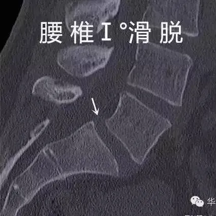 骶椎腰化/腰椎骶化、腰椎滑脫、腰肌勞損，簡單易懂圖解