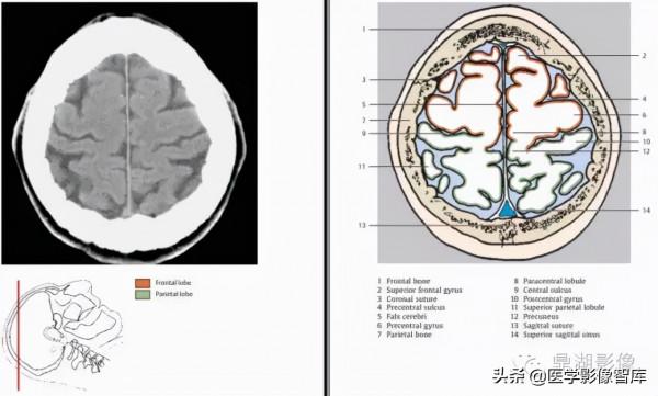 CT斷層解剖圖譜最全總結「推薦收藏」 CT斷層解剖圖譜最全總結「推薦收藏」