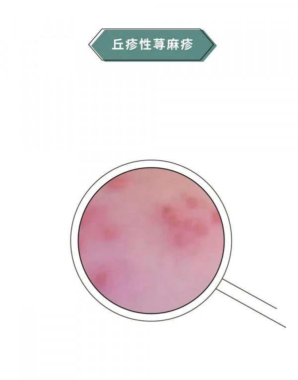 漫畫科普：“揹負”太多，“疹”的很累！