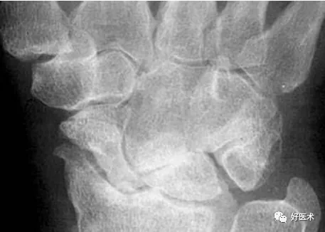 贊！腕關節X線高畫質解剖+腕骨脫位典型病例