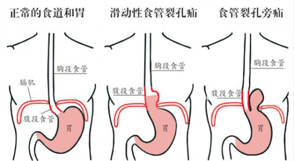 胸悶、胸痛...不一定是冠心病