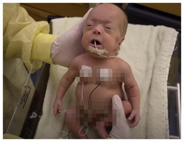 26周早產兒，出生不到1斤只有巴掌大，奇蹟生還長成大美人