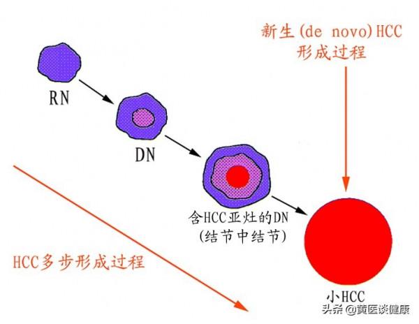 乙肝肝硬化階段,透過積極抗病毒和保肝治療後,效果欠佳怎麼辦? 乙肝肝硬化階段,透過積極抗病毒和保肝治療後,效果欠佳怎麼辦?