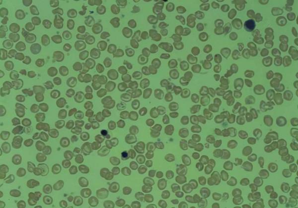 這是得了什麼病?美國女子熱衷吃牆皮,7年竟吃掉100多平方米 這是得了什麼病?美國女子熱衷吃牆皮,7年竟吃掉100多平方米
