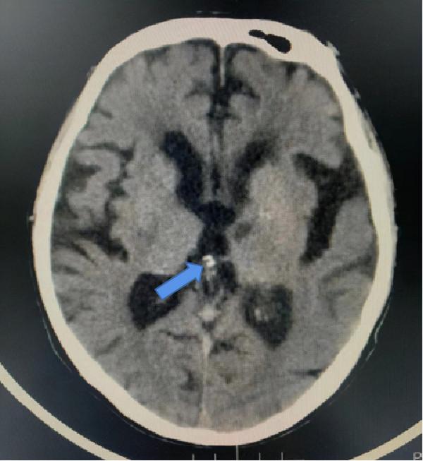 去醫院體檢，CT報告上那些不用過於擔心的診斷結果