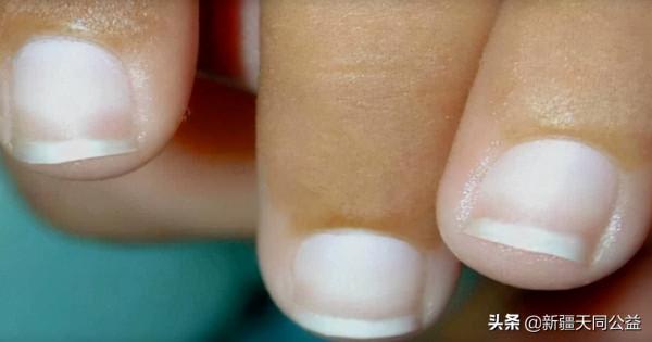 瞭解艾滋病引起的指甲變化