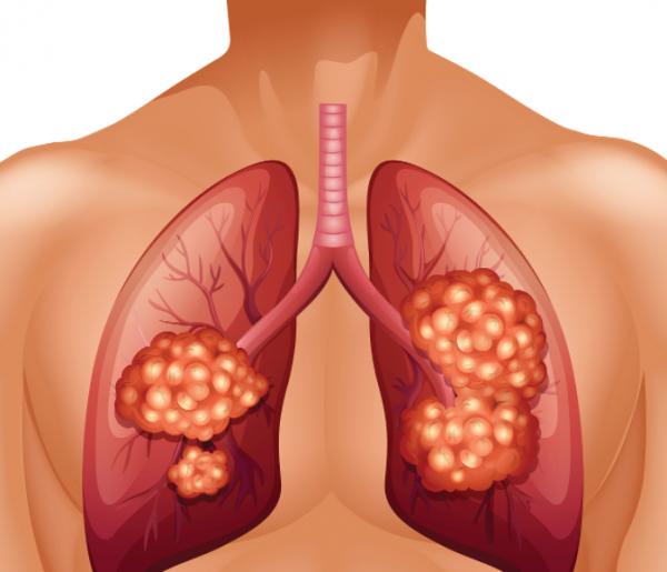 什麼是肺鱗癌？相比肺腺癌是隱蔽性極強，傷害性極大的肺癌