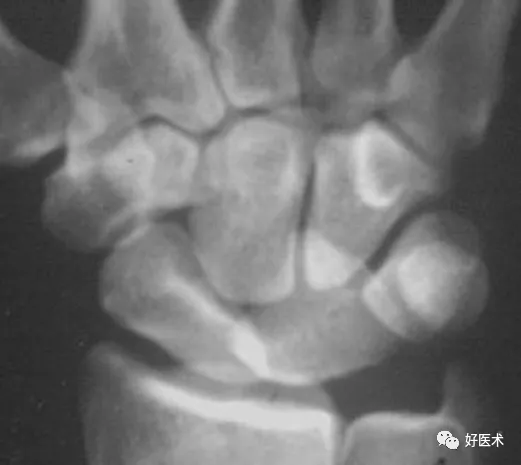 贊！腕關節X線高畫質解剖+腕骨脫位典型病例