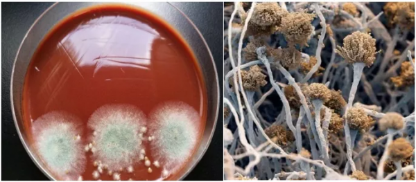 反覆咳嗽10多年,原來是肺發黴了,這種致病菌在自然界";存在感";很強 反覆咳嗽10多年,原來是肺發黴了,這種致病菌在自然界";存在感";很強