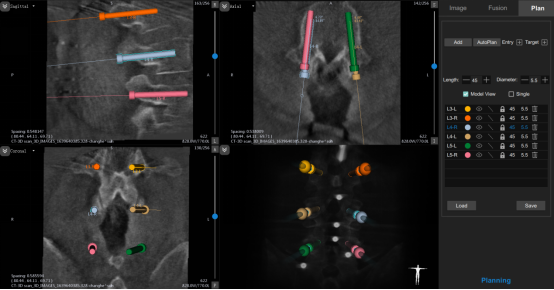 中國醫大一院新術式為腰椎管狹窄症患者解病痛