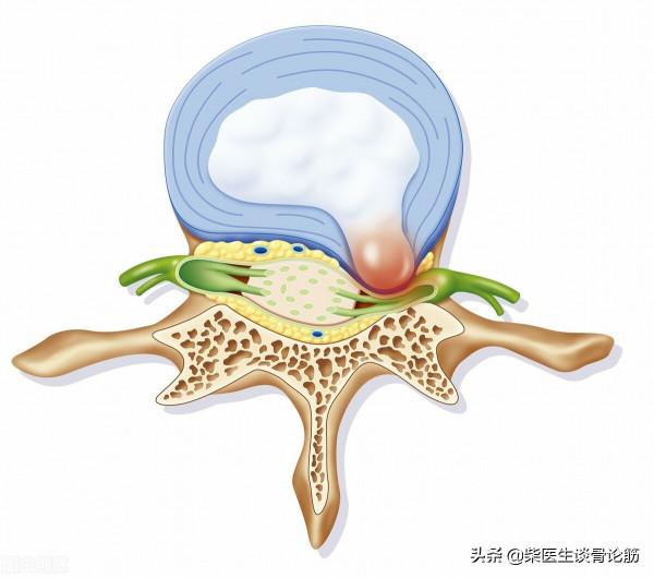 常見的兩種腰痛,你是哪一種?不要走進治療誤區 常見的兩種腰痛,你是哪一種?不要走進治療誤區