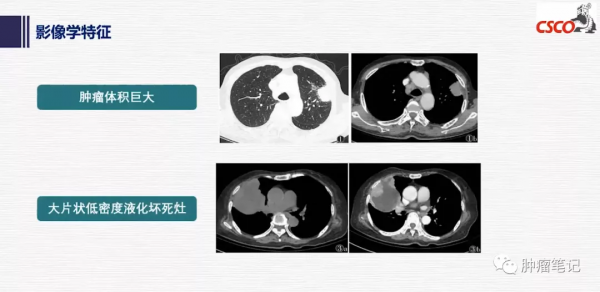 肺肉瘤樣癌治療進展