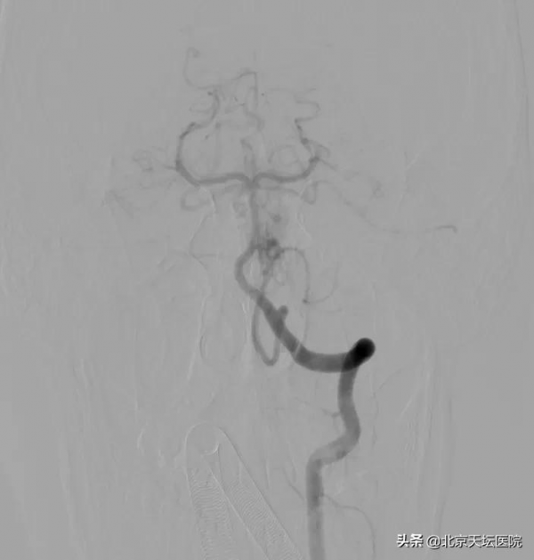 歷時9個半小時 動靜脈畸形出血少年轉危為安