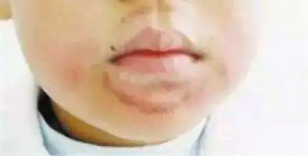 娃睡覺張嘴越長越醜？很多小孩都有的腺樣體肥大，一文說清