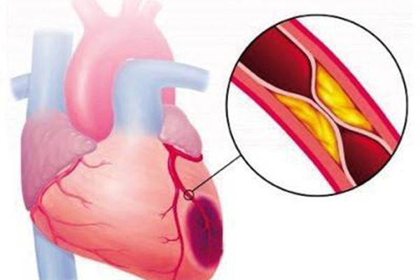 比高脂飲食更傷身的是1種飲食習慣，不少國人中招了，如何避免？
