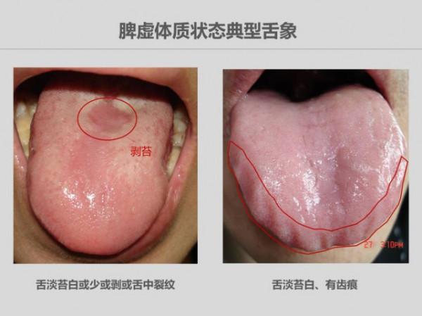 6歲女孩眼袋大，被診斷為脾虛，面部出現四種問題，及時健脾