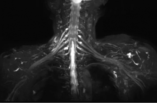 遼寧省腫瘤醫院醫學影像科開展助力患者術前診斷、術後隨訪的3&period;0T磁共振神經成像技術