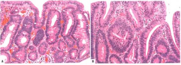 早期胃癌病理診斷：WHO VS.日本標準一文解析