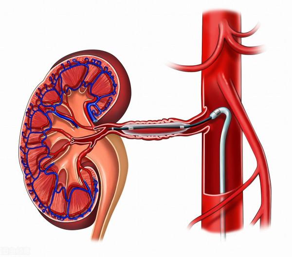 高血壓吃幾種藥也控制不好？新專家共識：手術療法或可有助降壓