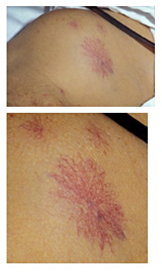 慢性肝病的8大常見體檢發現，是什麼原因引起的？醫生告訴你