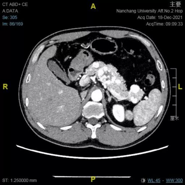 南昌大學二附院耳鼻咽喉頭頸外科成功診治鼻腔鼻竇轉移性腎透明細胞癌患者