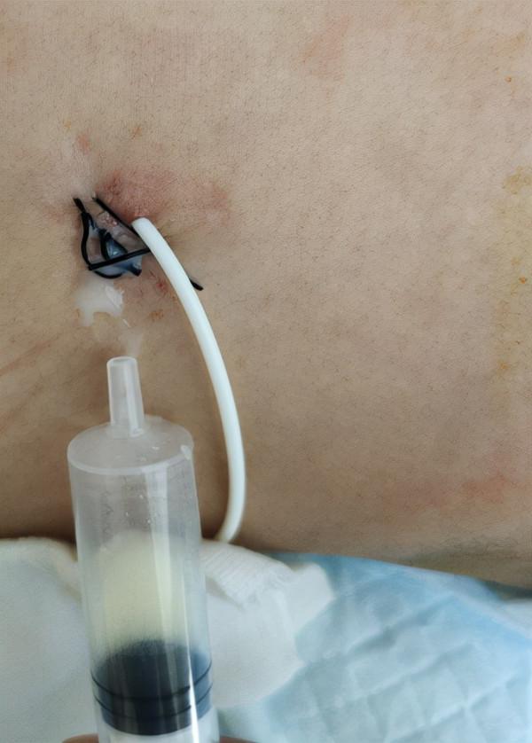 顱內生殖細胞瘤切除術後腦積水仍反覆,意識模糊,左側肢體偏癱 顱內生殖細胞瘤切除術後腦積水仍反覆,意識模糊,左側肢體偏癱