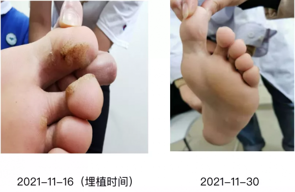 手腳悄悄長出小硬結？這到底是怎麼回事哩？